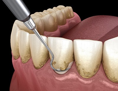 A CGI of scaling and root planing treatment
