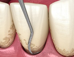 A CGI of teeth during a scaling and root planing procedure