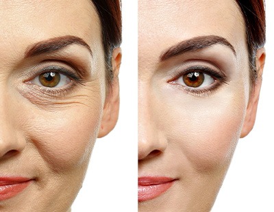 A woman before and after BOTOX