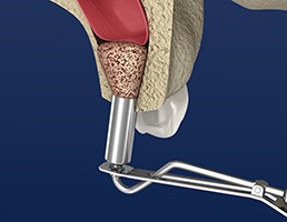 a computer illustration showing a medical device lifting the maxillary sinuses