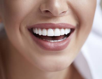 Closeup of smile after porcelain veneers