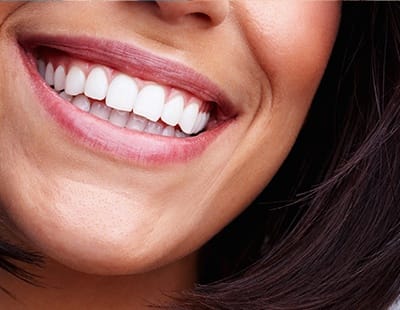 Brilliant smile after teeth whitening