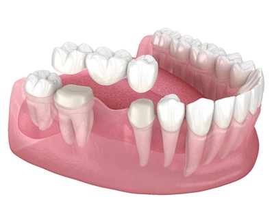 A digital image of a dental bridge resting over two healthy teeth and on top of the gums