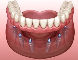digital illustration of dental implant dentures