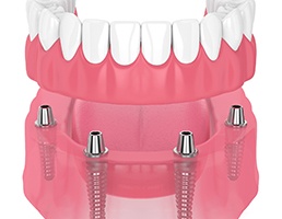 illustration of implant dentures 