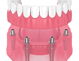 illustration of implant dentures