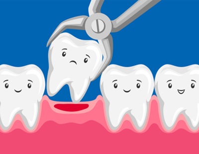 Illustration of a tooth extraction