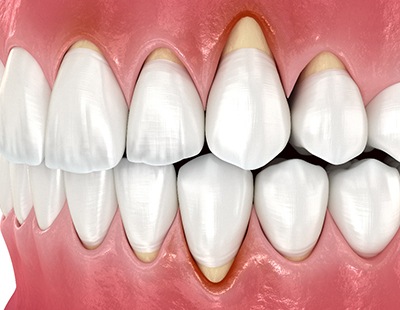 Illustration of receding gums