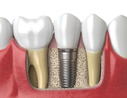 closeup of dental implant in Ellicott City