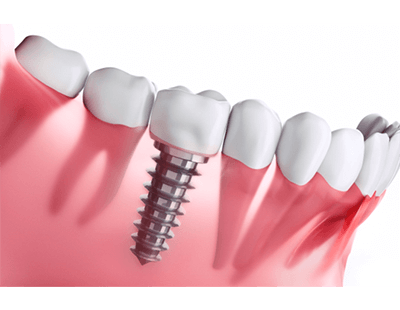 Digital illustration of dental implants in Ellicott City
