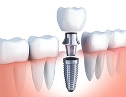 Animated dental implant supported dental crown placement