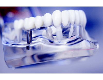 model jaw with dental implants in Ellicott City