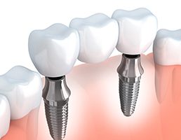 Animated dental implant supported fixed bridge placement