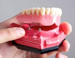 Model dental implant supported denture