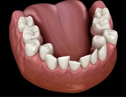 Illustration of crowded teeth