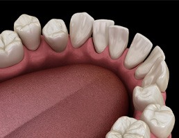 Illustration of gapped teeth