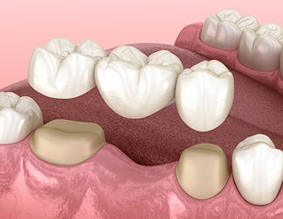 Animated dental bridge placement