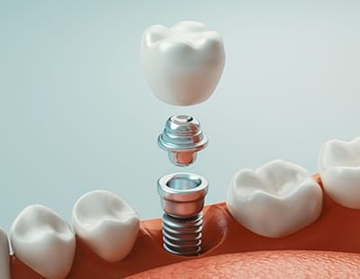 Animated dental implant supported dental crown placement