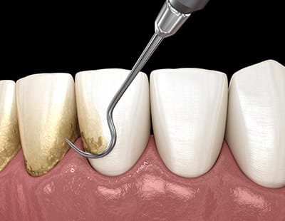 Animated smile receiving scaling and root planing treatment