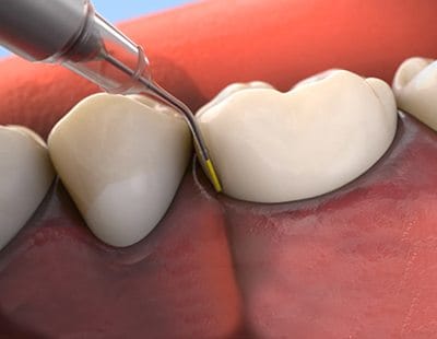 Animated antibiotic therapy