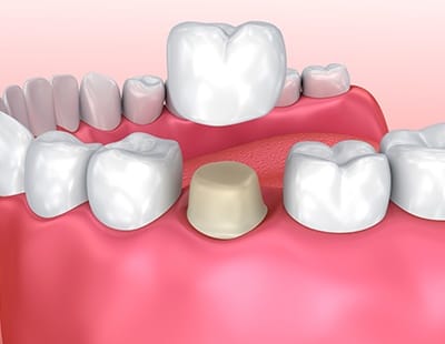 Animated dental crown restoration placement