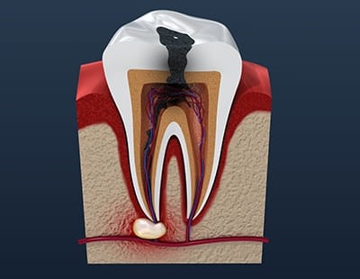 Animated tooth in need of root canal therapy