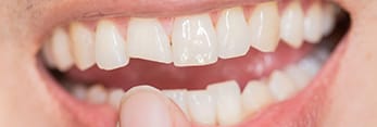 Closeup of smile with broken tooth before restorative dentistry