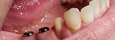Dental implants in empty tooth socket