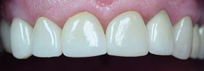 Brilliant white healthy smile