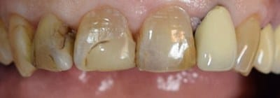 Decayed and discolored teeth