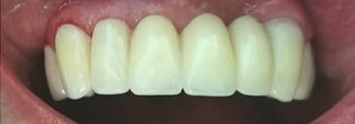 Flawless replacement teeth