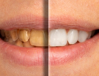 A before and after image of a patient who received teeth whitening treatment