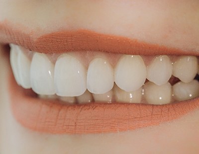 Woman smiling with veneers in Ellicott City