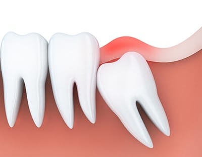 Animated smile with an impacted wisdom tooth