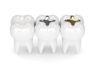 Dental fillings.