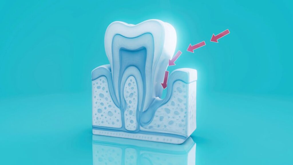 A CGI of a periodontal pocket around a tooth